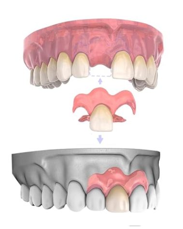 Custom Partial Dentures - Include DIY Dental Impression Kit, Lightweight & Unbreakable Replacement Denture for Men & Women